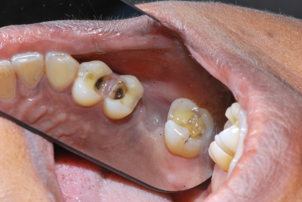 Inlay amalgames dépose - Cabinet dentaire du lagon