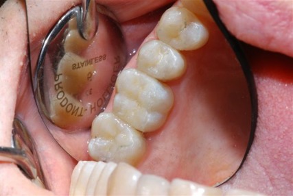 Inlay posé en bouche - Cabinet dentaire du lagon